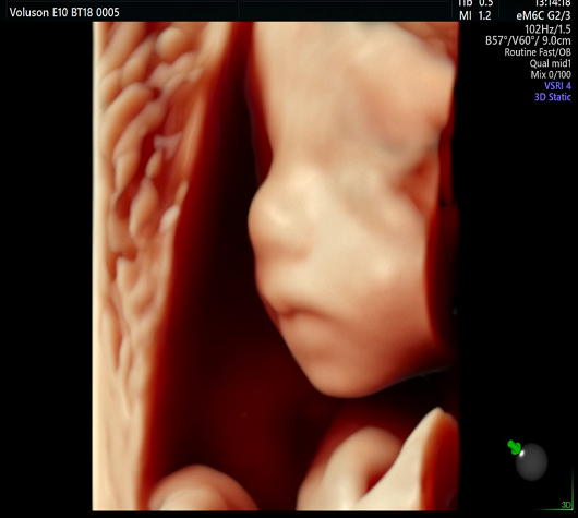 双胎的胎儿系统超声（四维彩超），可不是简单的“1+1”！
