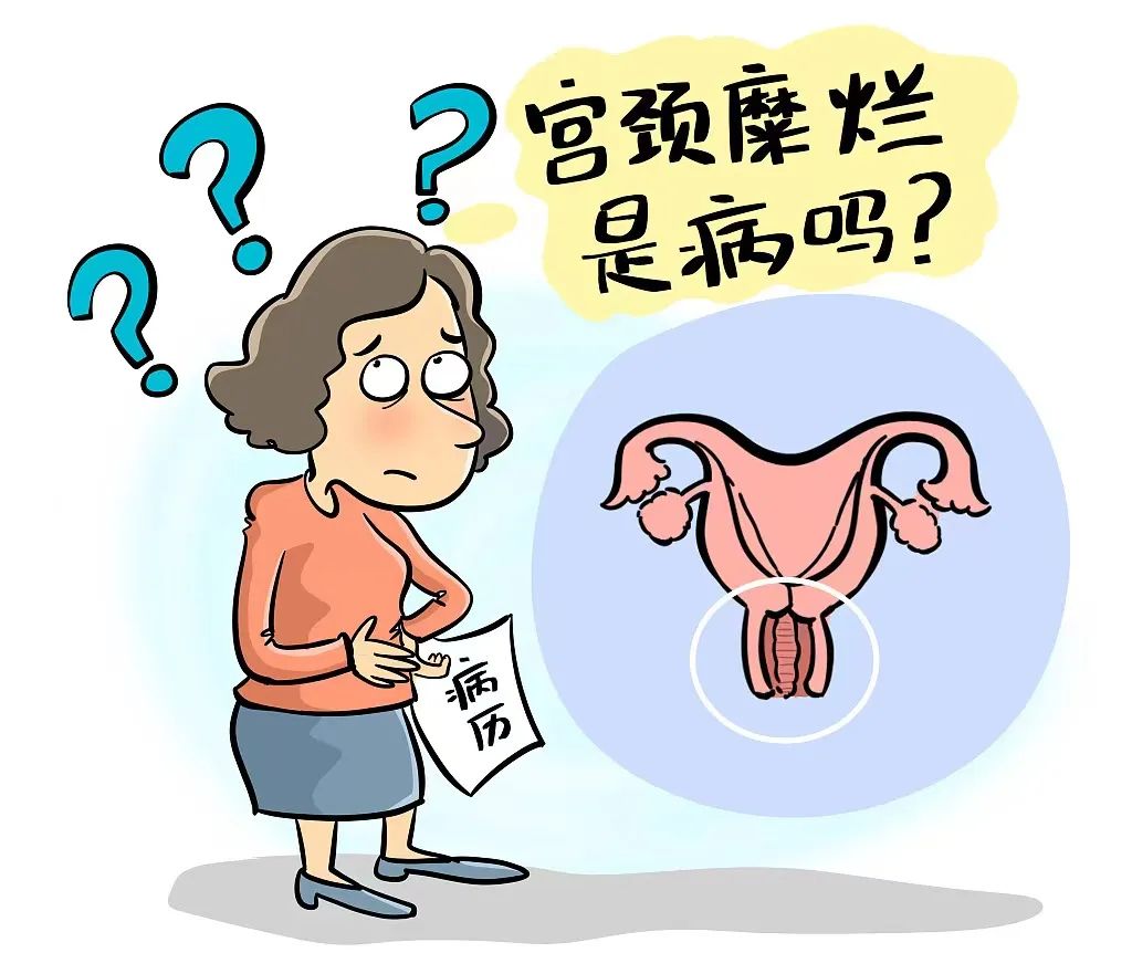 宫颈糜烂