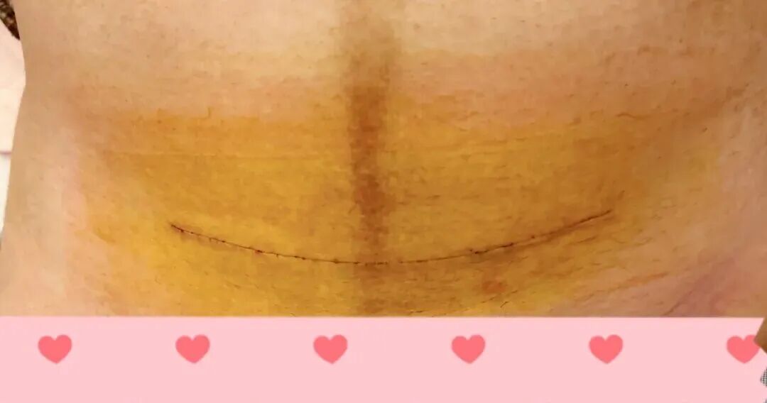 疤痕美,切口小且隐蔽 疤痕美,切口小且隐蔽