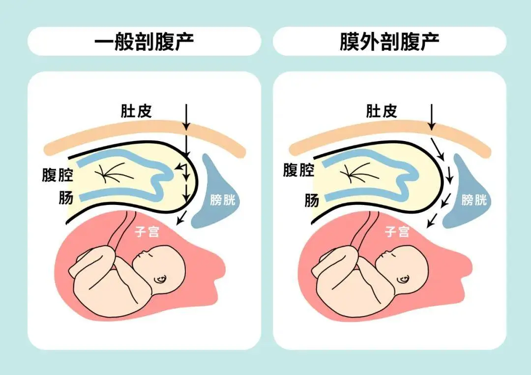 什么是腹膜外剖宫产 什么是腹膜外剖宫产