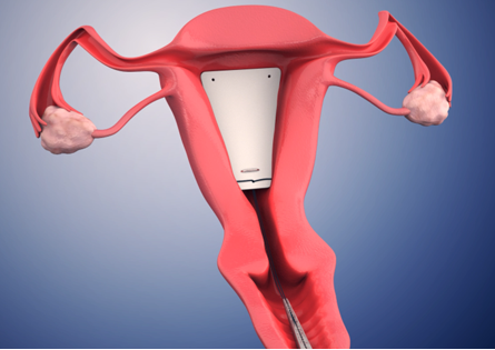 子宫药物支架适合哪些人