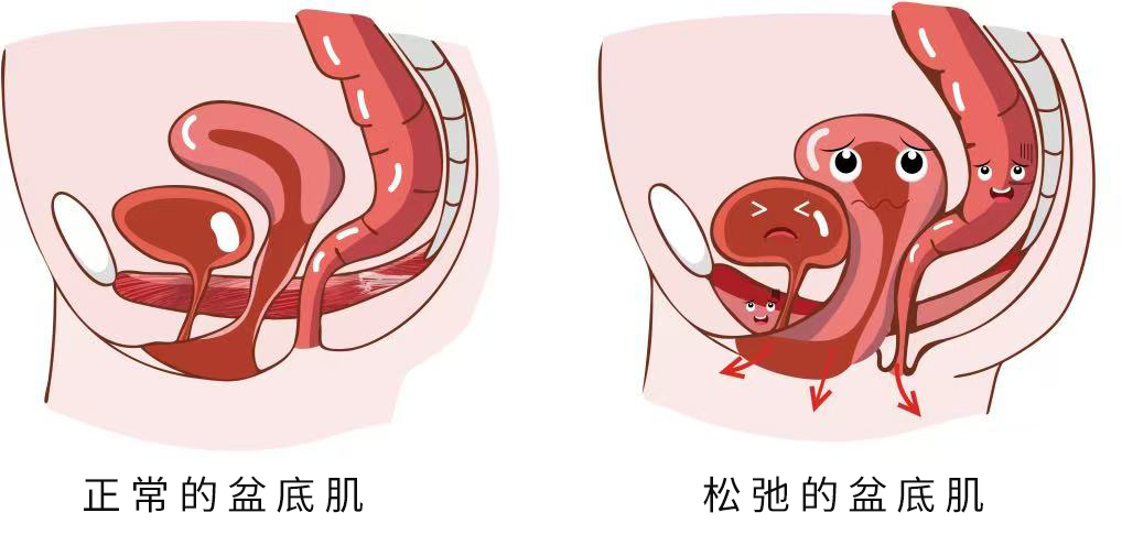 正常盆底肌 正常盆底肌