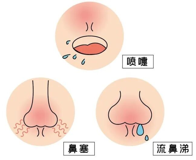 鼻炎 鼻炎