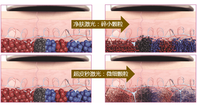 超皮秒击碎