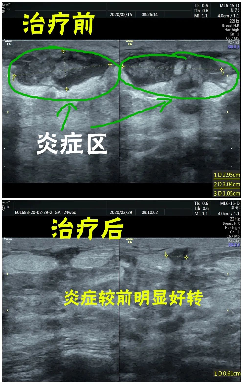 乳腺炎治疗