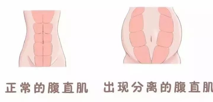 腹直肌分离