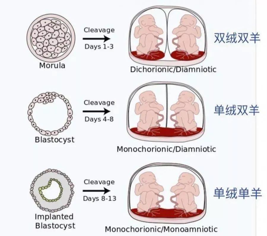 单卵双胎图片